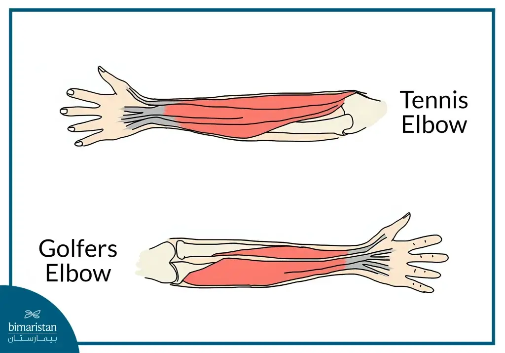 An Image Showing The Difference Between Tennis Elbow And Golfer’s Elbow.