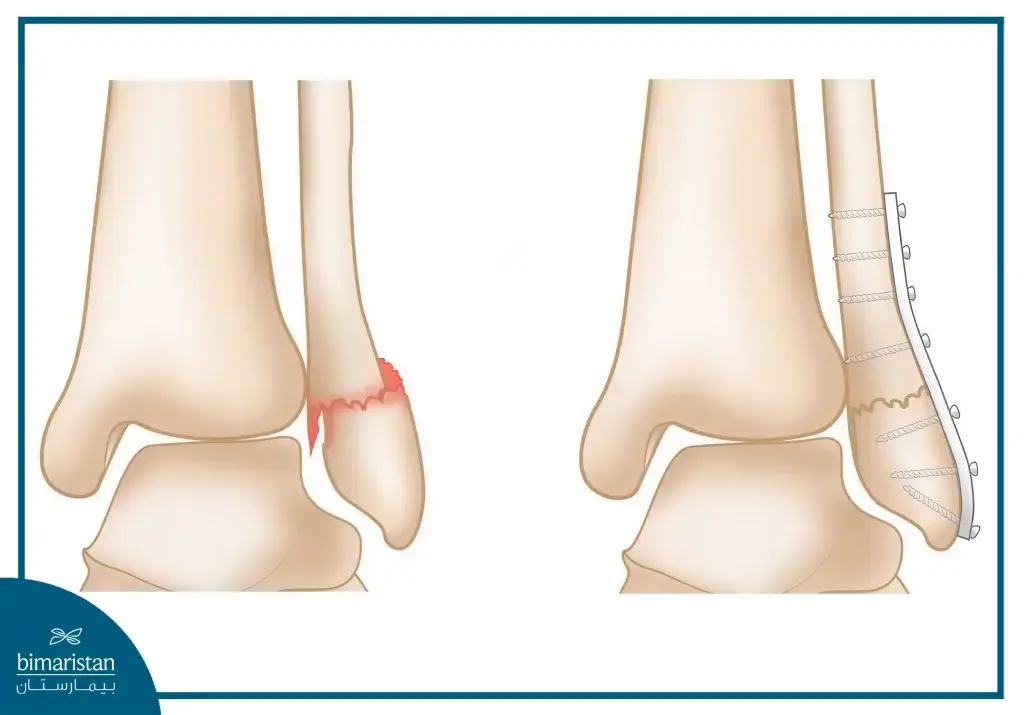 The Image Shows A Surgical Procedure To Fix An Ankle Fracture Using Metal Screws.