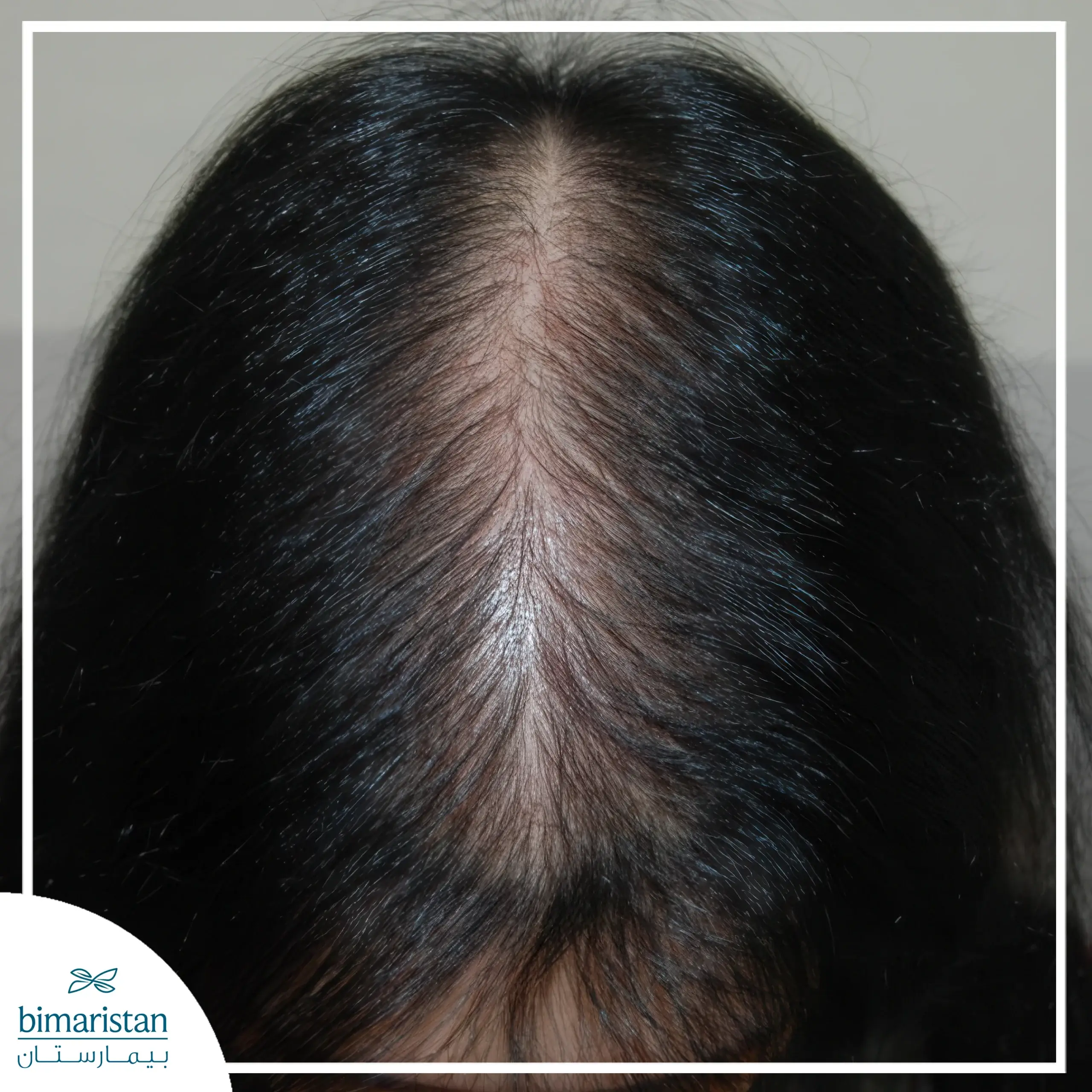Reasons For Hair Loss In Women And Its Treatment 4 Image Of Androgenic Alopecia.