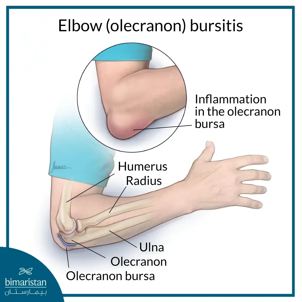The Image Shows Elbow Bursa Inflammation Caused By Repetitive Pressure Or Injury.