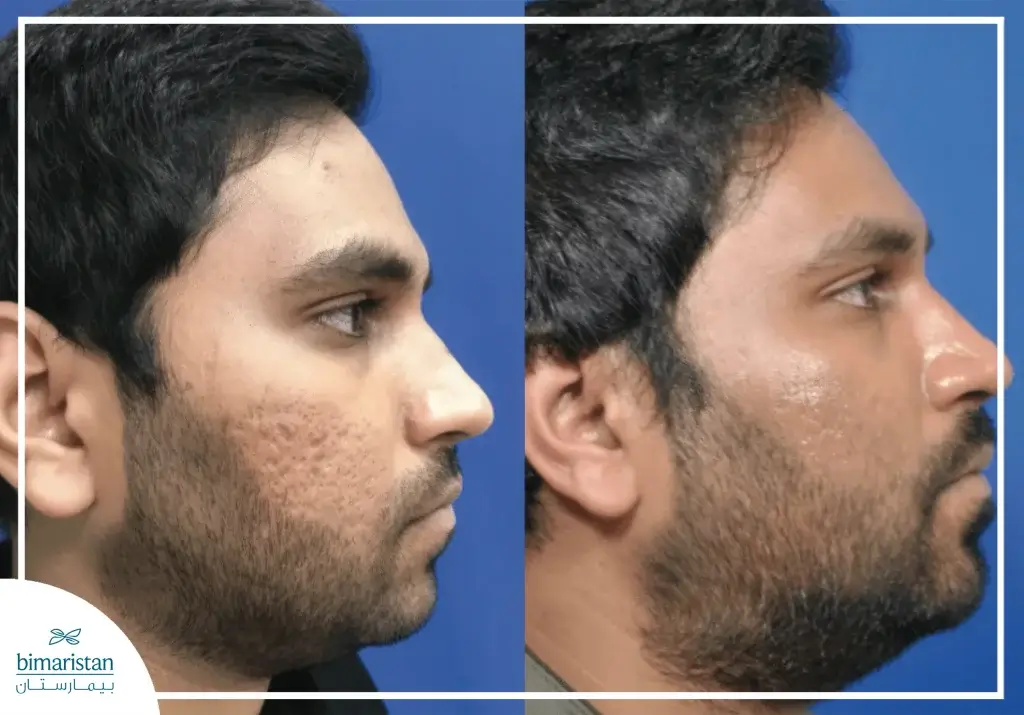 Benefits Of Prp For Hair And Face In Turkey 3 Before And After Plasma Injections For Hair And Face In Turkey