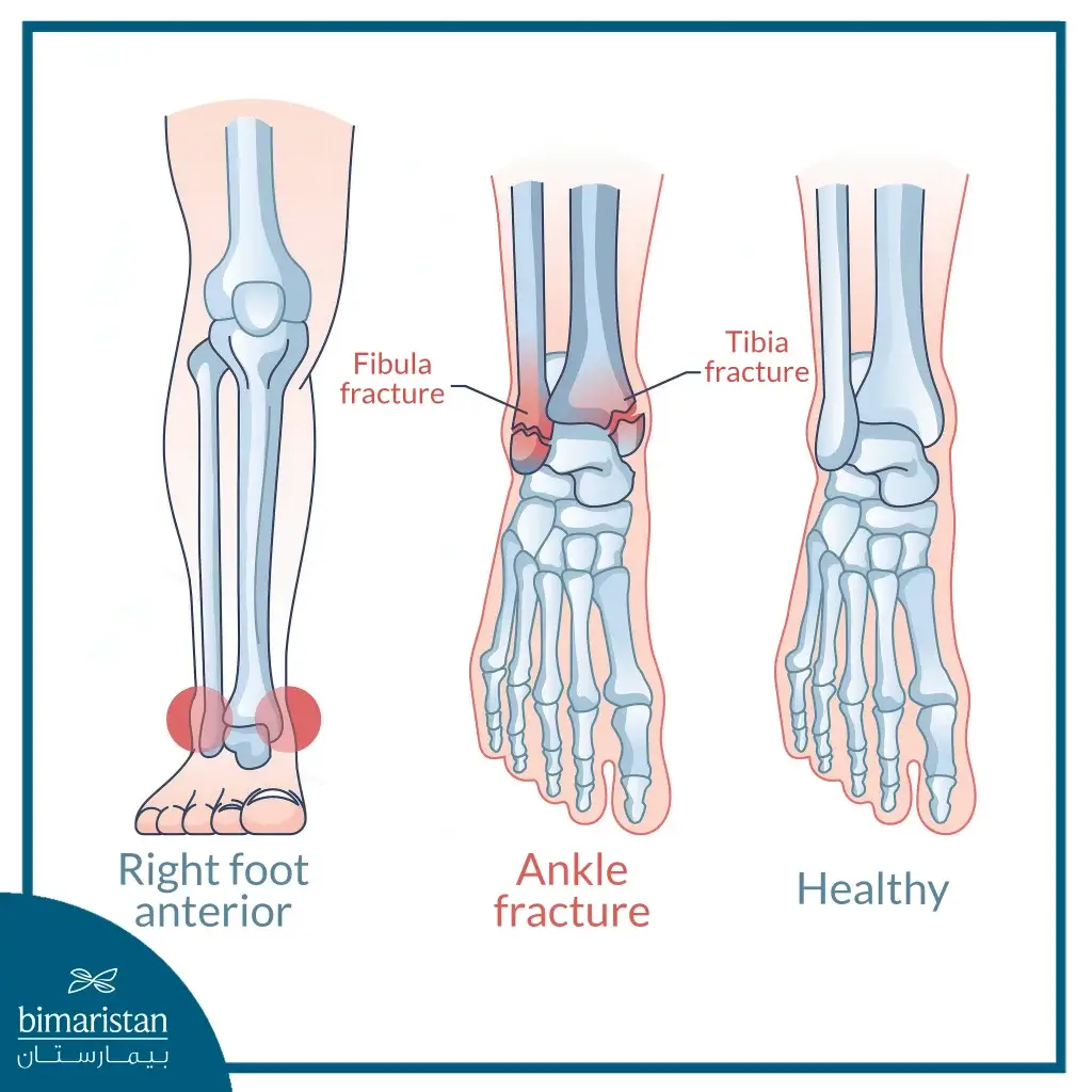 An Image Illustrating Examples Of Ankle Fractures, Highlighting Different Injury Sites In The Bones Associated With The Joint.