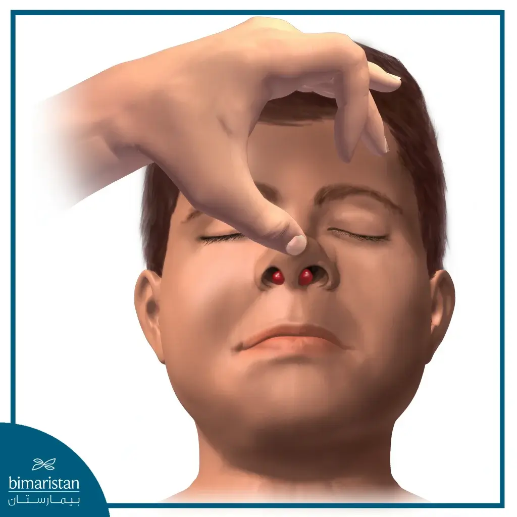 An Image Showing A Hematoma In The Nasal Septum, Appearing As A Swollen Mass With A Purple Hue.