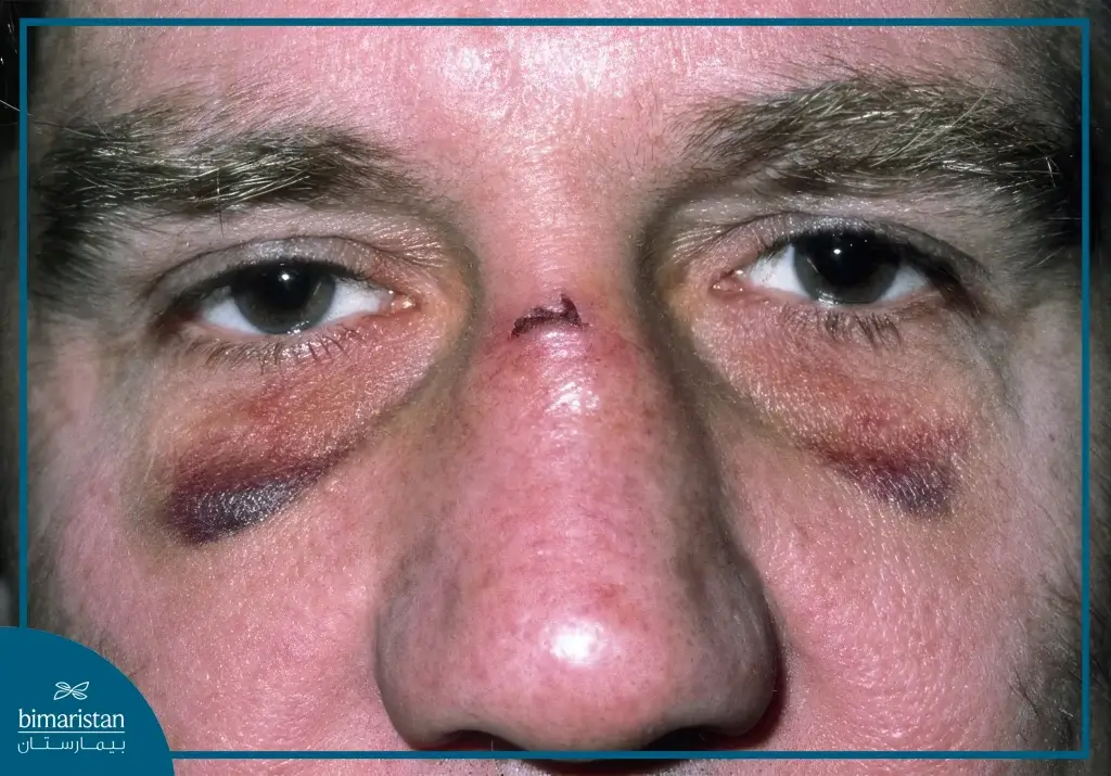 The Image Illustrates Swelling In The Periorbital Area Due To A Nasal Fracture.