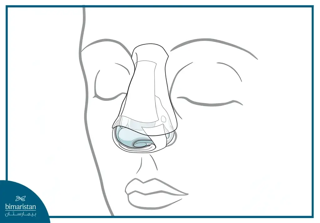 An Image Shows The Application Of A Splint On The Nose To Ensure The Stability Of The Aligned Bones And Proper Healing During The Recovery Period.