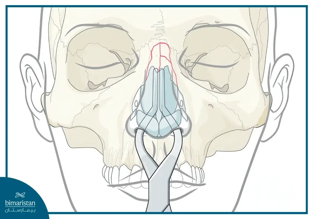The Image Illustrates The Use Of Walsham Forceps To Stabilize A Nasal Fracture And Ensure The Stability Of The Broken Bone.