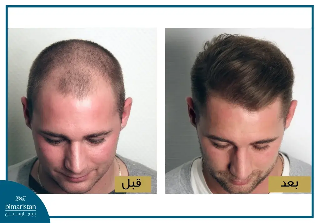 زراعة الشعر بطريقة نيوجرافت في تركيا 5 صورة لمريض مصاب بالصلع قبل وبعد إحراء عملية زراعة الشعر بطريقة نيوجرافت