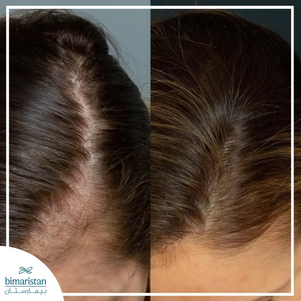 Benefits Of Prp For Hair And Face In Turkey 2 Before And After Plasma Injections For Hair In Turkey