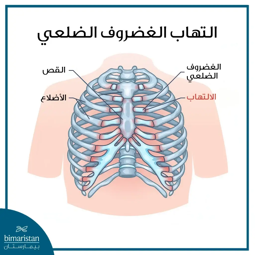 التهاب الغضروف الضلعي وطرق علاجه 4 صورة تُظهر علامات التهاب في الغضروف الضلعي ضمن القفص الصدري.