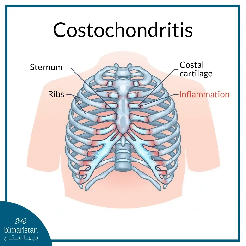 An Image Demonstrating Signs Of Inflammation In The Costal Cartilage Within The Thoracic Cage.