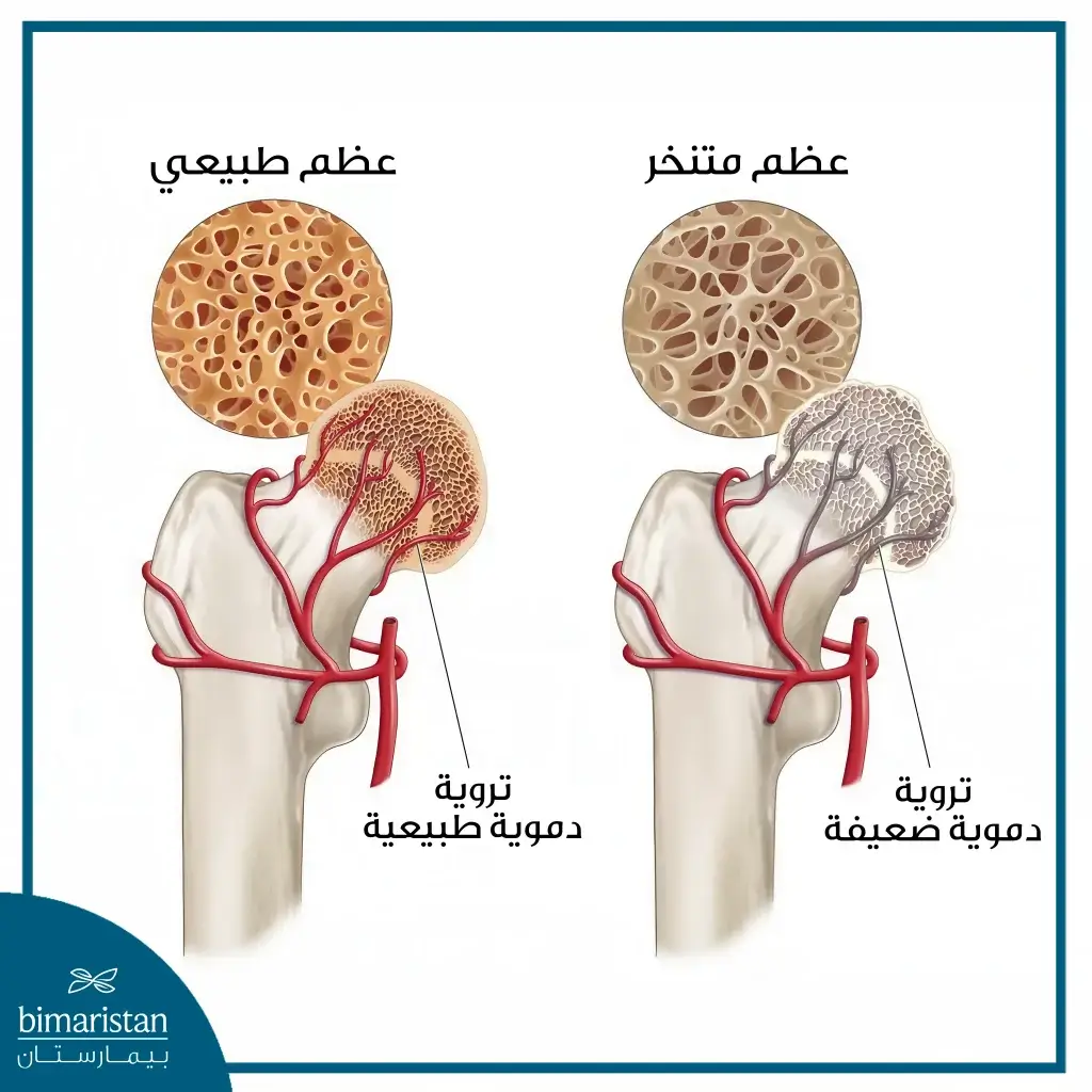 صورة تبين الفرق بين عظم ذو تروية طبيعية وعظم متنخر