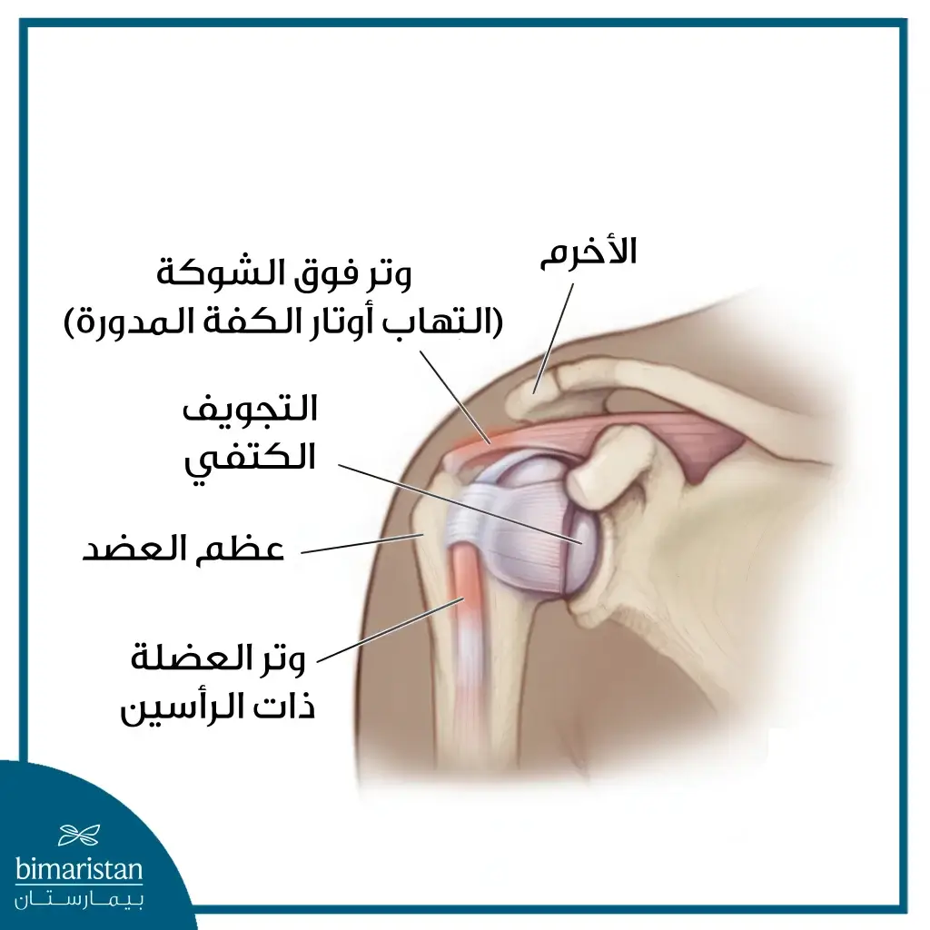 علاج التهاب أوتار الكتف: برنامح متدرج للتعافي خطوة بخطوة 12 الصورة تُظهر التهابًا في أوتار عضلات مفصل الكتف.