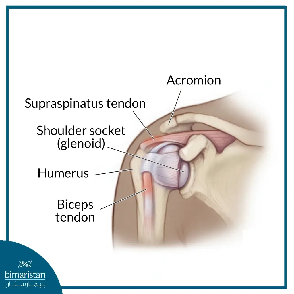 The Image Shows Inflammation In The Tendons Of The Shoulder Joint Muscles.