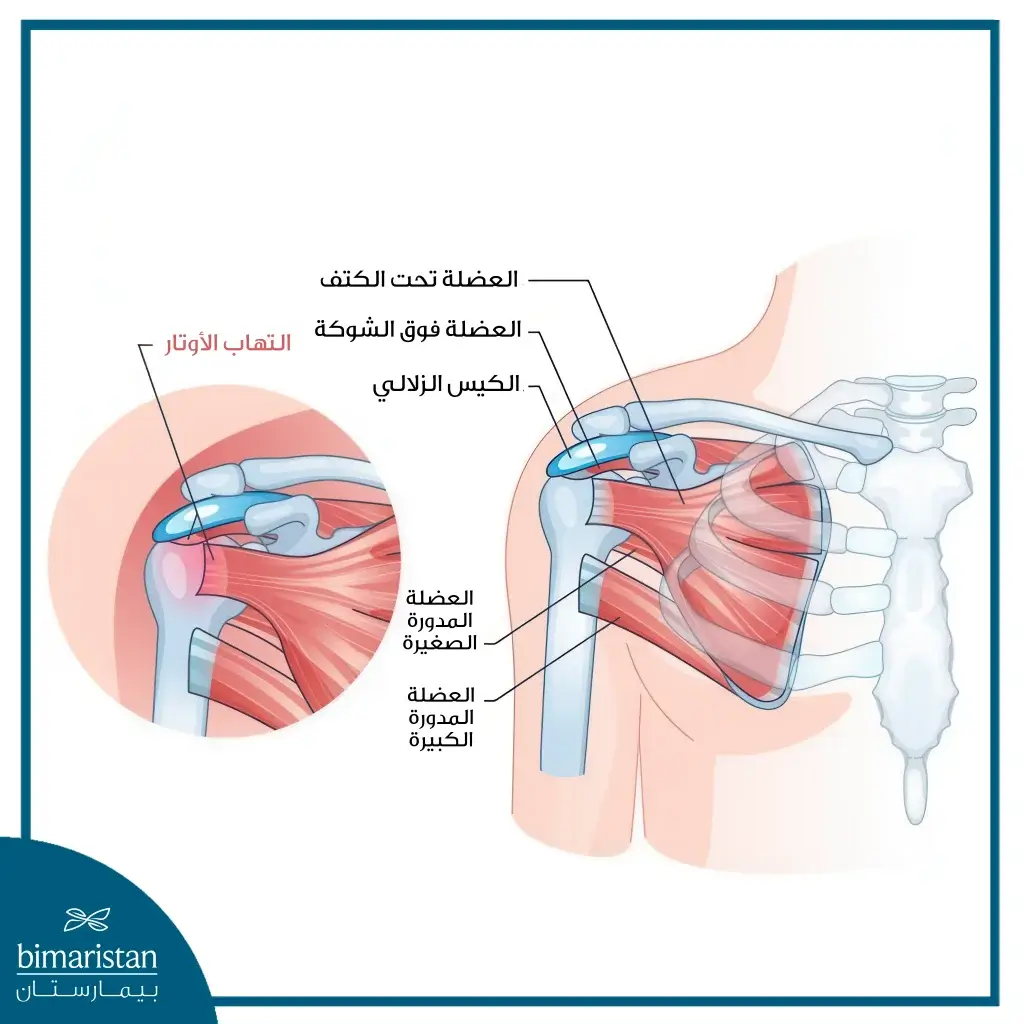 علاج التهاب أوتار الكتف: برنامح متدرج للتعافي خطوة بخطوة 10 الصورة تُظهر التوضع التشريحي لمفصل الكتف مع العضلات المختلفة المحيطة به.