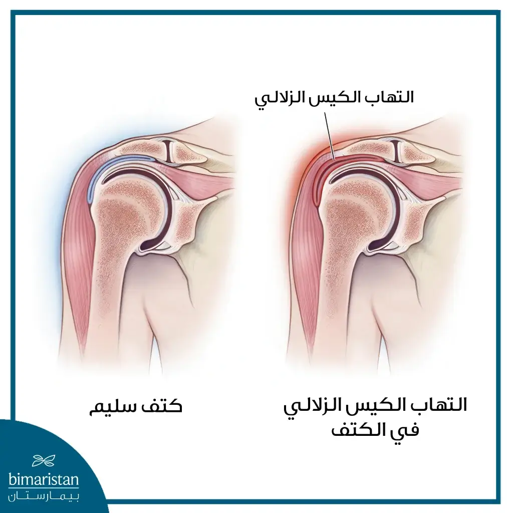 علاج التهاب أوتار الكتف: برنامح متدرج للتعافي خطوة بخطوة 11 صورة توضح حالة التهاب الكيس الزليلي في الكتف.