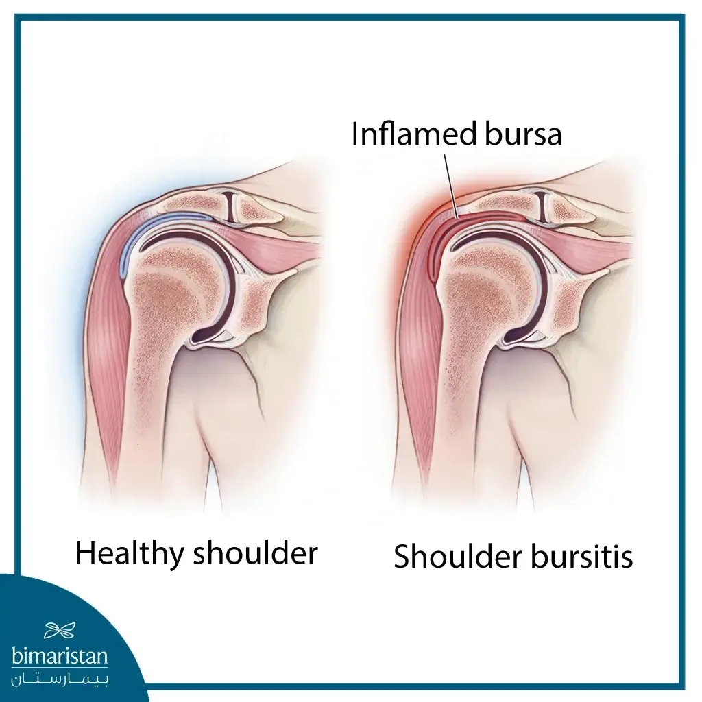 The Image Illustrates The Condition Of Bursa Inflammation In The Shoulder.