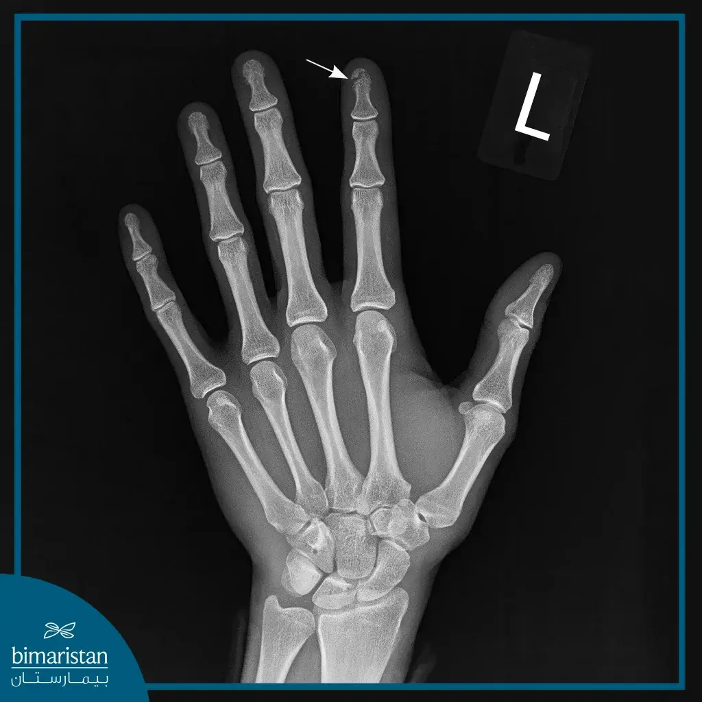 Finger Fractures: Clinical Assessment And Treatment Options 7 An X-Ray Image Showing The Bony Anatomy Of The Hand Region.