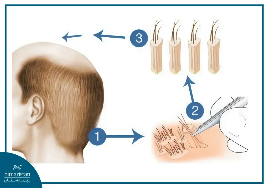 Best Fue Hair Transplant &Amp; Its Cost 2 Fue Hair Transplant Technique In Turkey