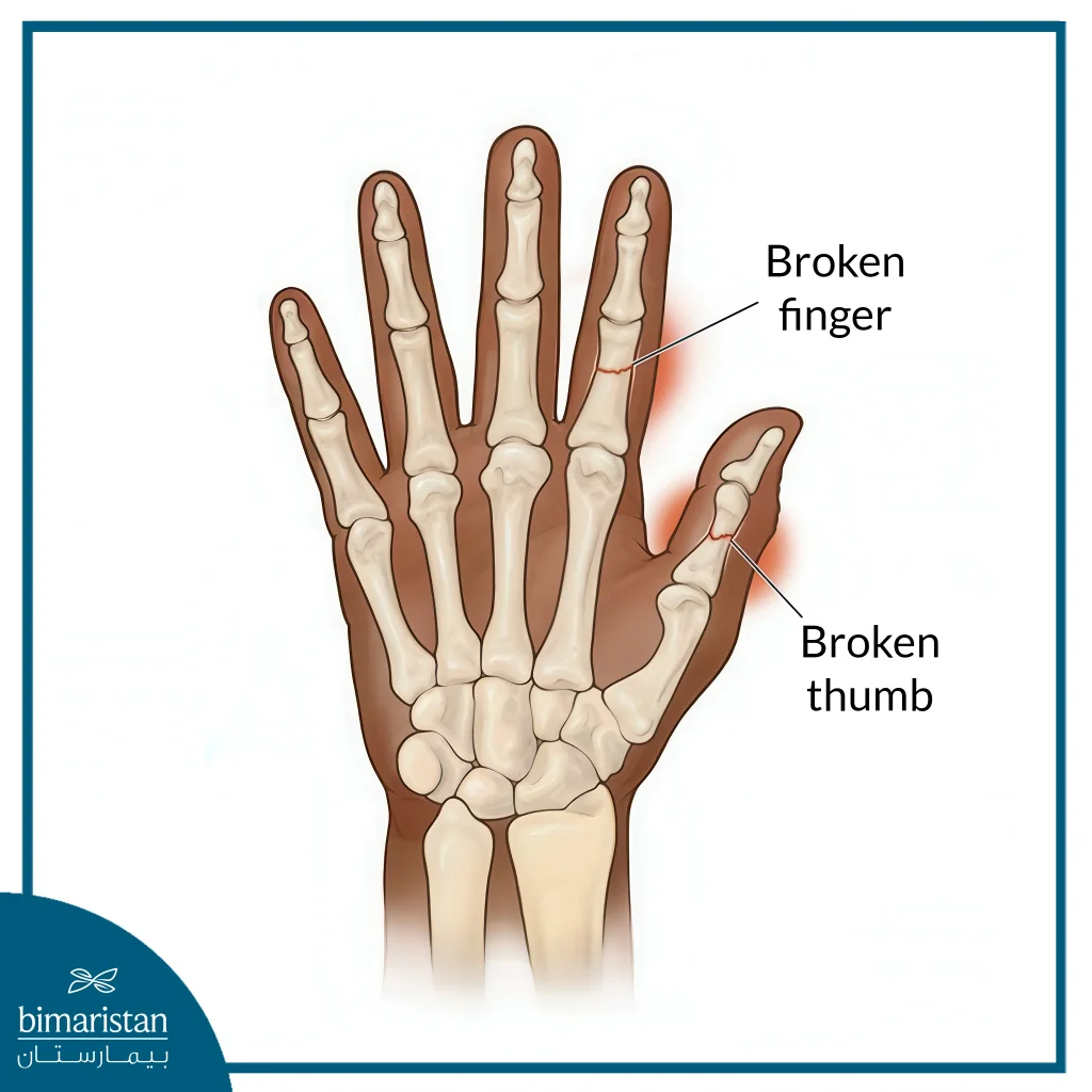 Finger Fractures: Clinical Assessment And Treatment Options 6 An Image Illustrates The Anatomical Positioning Of The Hand Bones.