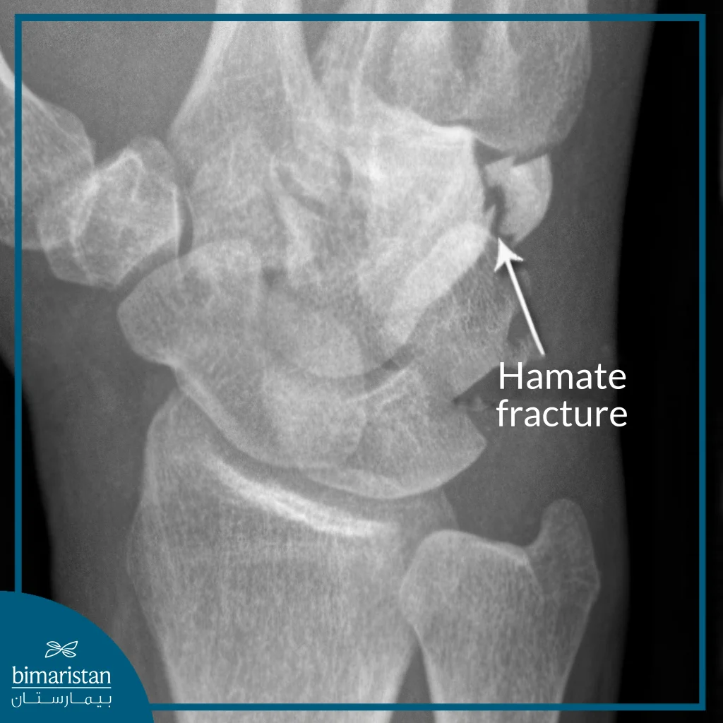 The Radiographic Image Shows A Fracture In The Wrist Region.