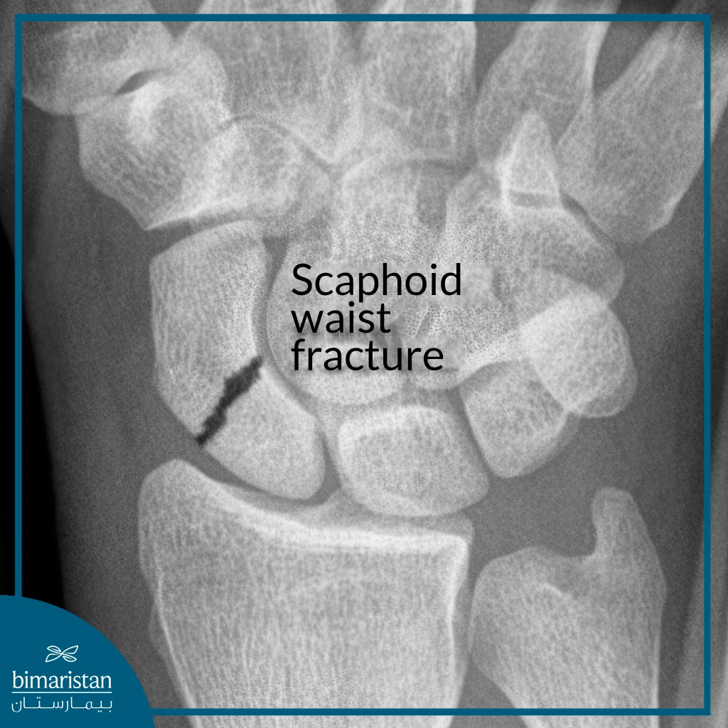 The Radiographic Image Shows A Fracture In The Wrist Region.