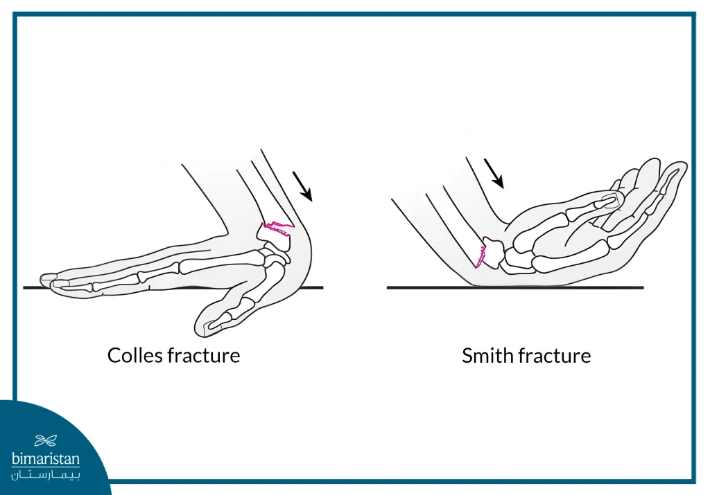 The Image Illustrates The Anatomical Difference Between Smith'S Fracture And Colles' Fracture Of The Distal Radius.