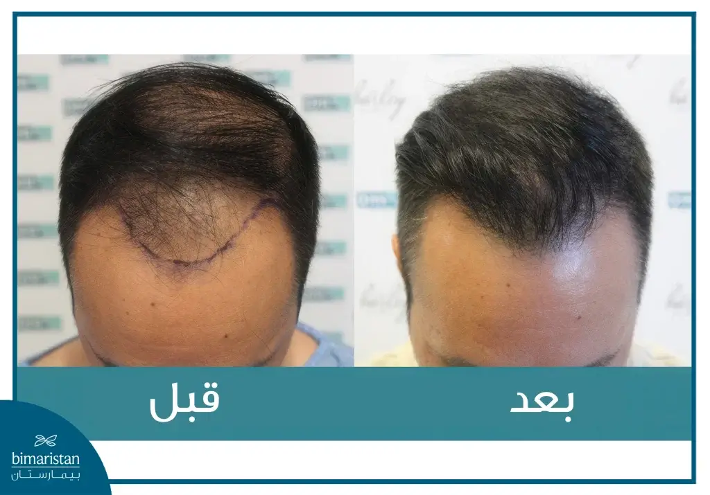 تقنية Dhi لزراعة الشعر في تركيا؛ ما هي ولمن تجرى؟ 4 صورة توضح النتيجة النهائية لمريض مصاب بالصلع في مقدمة فروة الرأس بعد إجراء تقنية Dhi لزراعة الشعر
