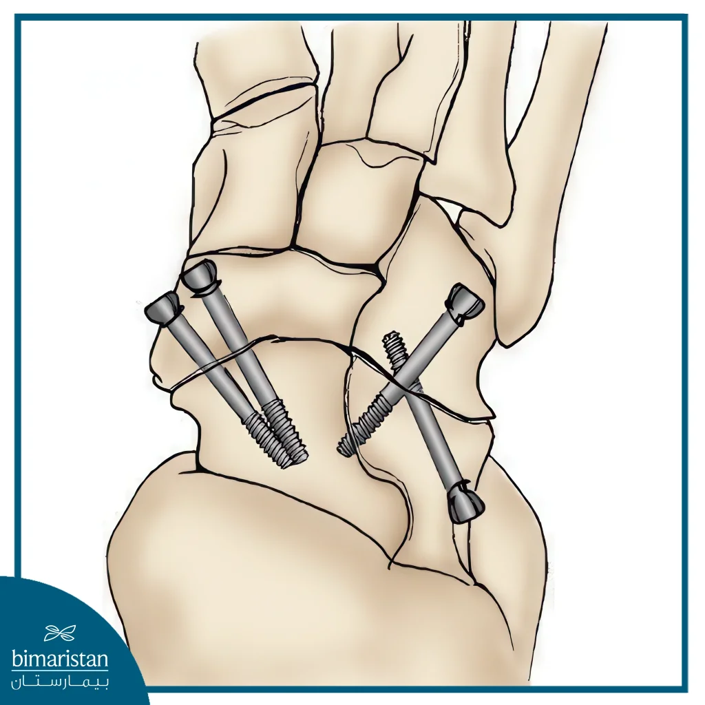 Arthrodesis Is A Surgical Procedure Aimed At Eliminating Movement In A Damaged Joint To Reduce Pain And Enhance Stability.