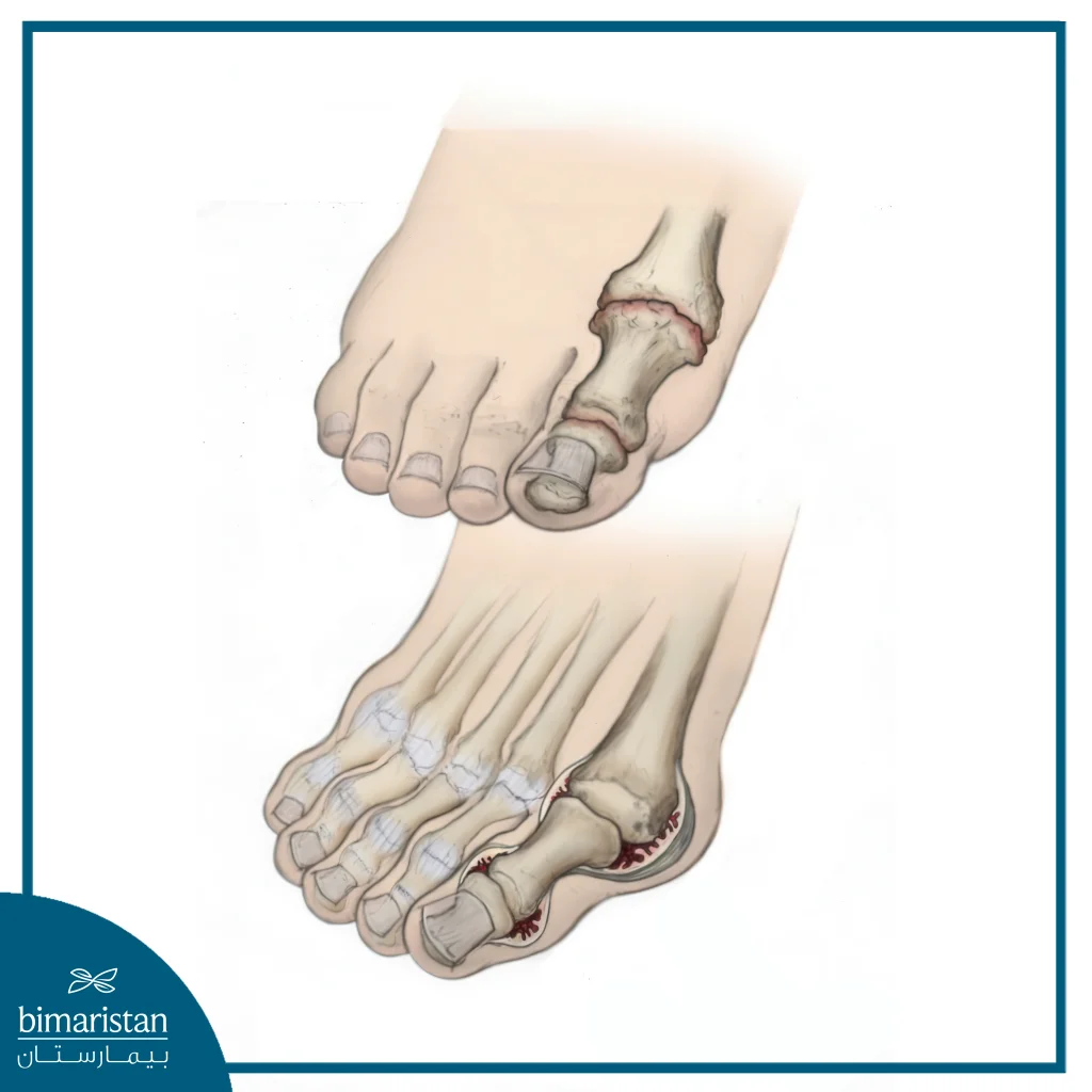 A Medical Image Illustrates Two Distinct Types Of Foot Joint Arthritis.