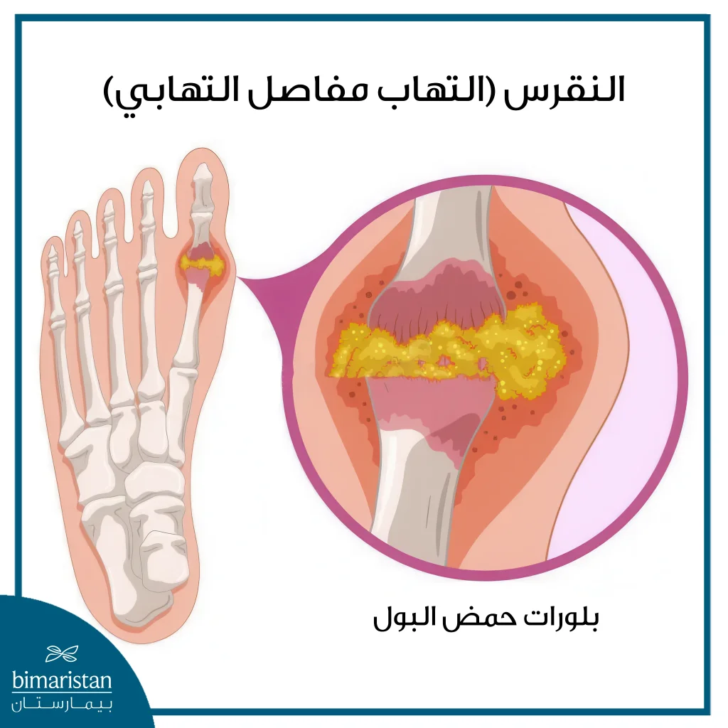 أنواع التهاب مفاصل القدم وطرق علاجه 11 تُظهر الصورة أحد أبرز أنماط الالتهاب المفصلي التي قد تؤثر على مفاصل القدم والكاحل.