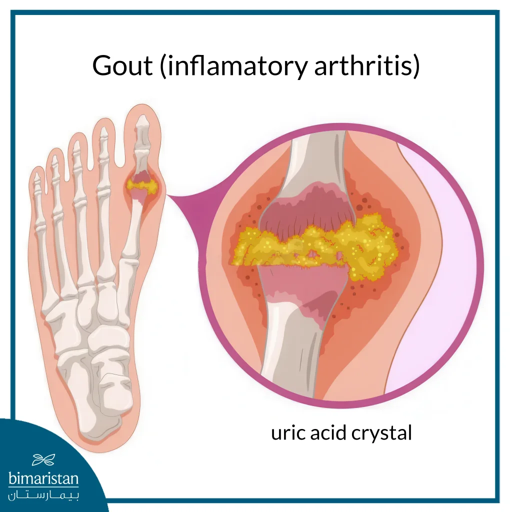 The Image Illustrates One Of The Most Prominent Types Of Arthritis That Can Affect The Foot And Ankle Joints.