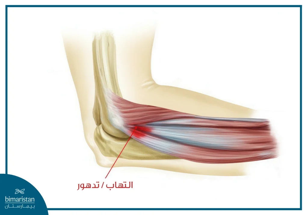 أهم طرق علاج مرفق التنس، الأسباب والأعراض 10 الصورة تُظهر المنطقة الملتهبة من المرفق.