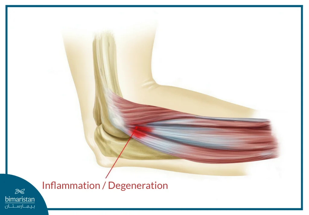 The Image Displays The Inflamed Region Of The Elbow.