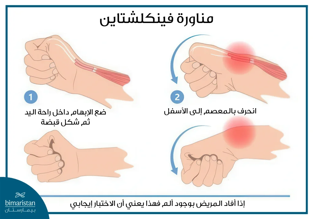 التهاب وتر الإبهام (متلازمة دي كورفان) 7 الصورة توضح الطريقة الصحيحة لأداء مناورة فينكلشتاين (Finkelstein'S Maneuver)، وهي اختبار سريري يُستخدم لتشخيص التهاب غمد الوتر في الإبهام.