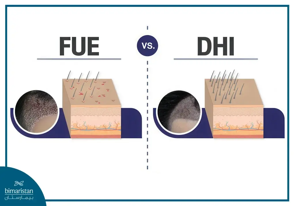 Dhi Hair Transplantation And Its Cost 2 Fue Vs Dhi Technique