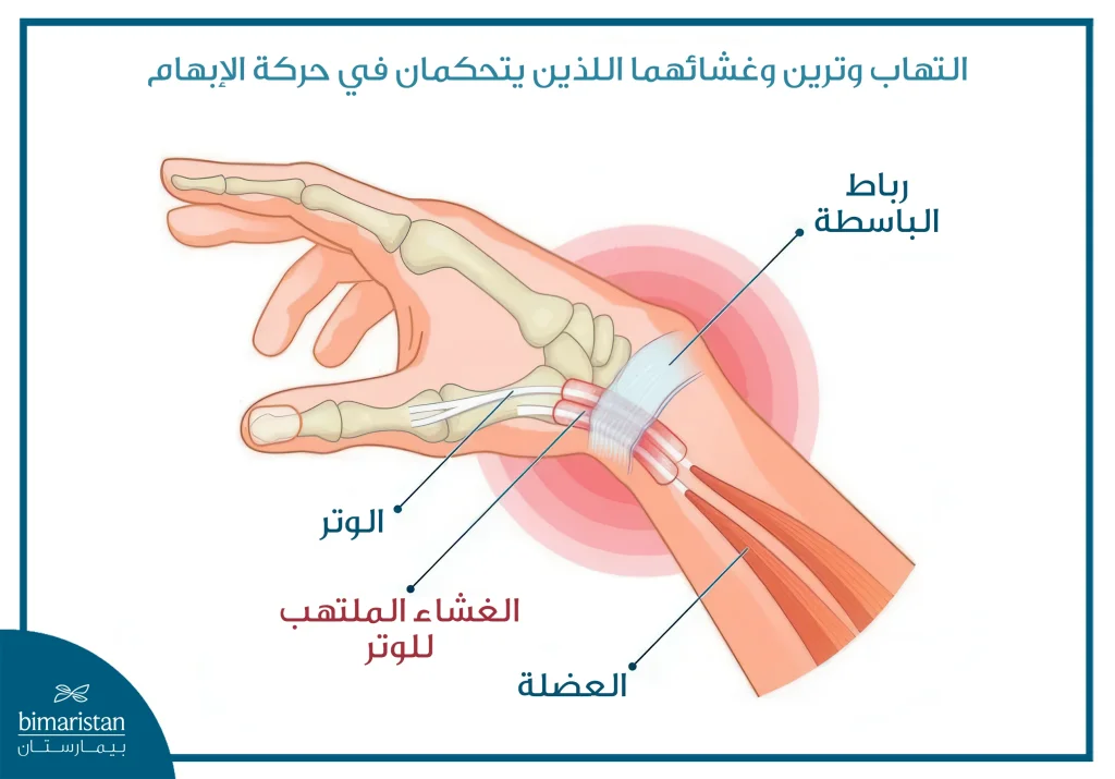 التهاب وتر الإبهام (متلازمة دي كورفان) 6 صورة تُظهر علامات التهاب وتر الإبهام في اليد، وهو ما يُعرف غالبًا بالتهاب غمد الوتر لديكورفان (De Quervain’s Tenosynovitis).