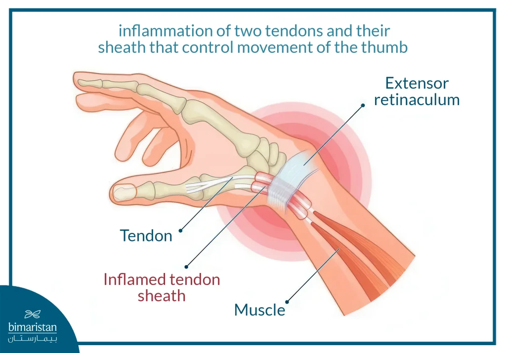 The Image Shows Signs Of Inflammation In The Thumb Tendon Of The Hand, Commonly Referred To As De Quervain’s Tenosynovitis.