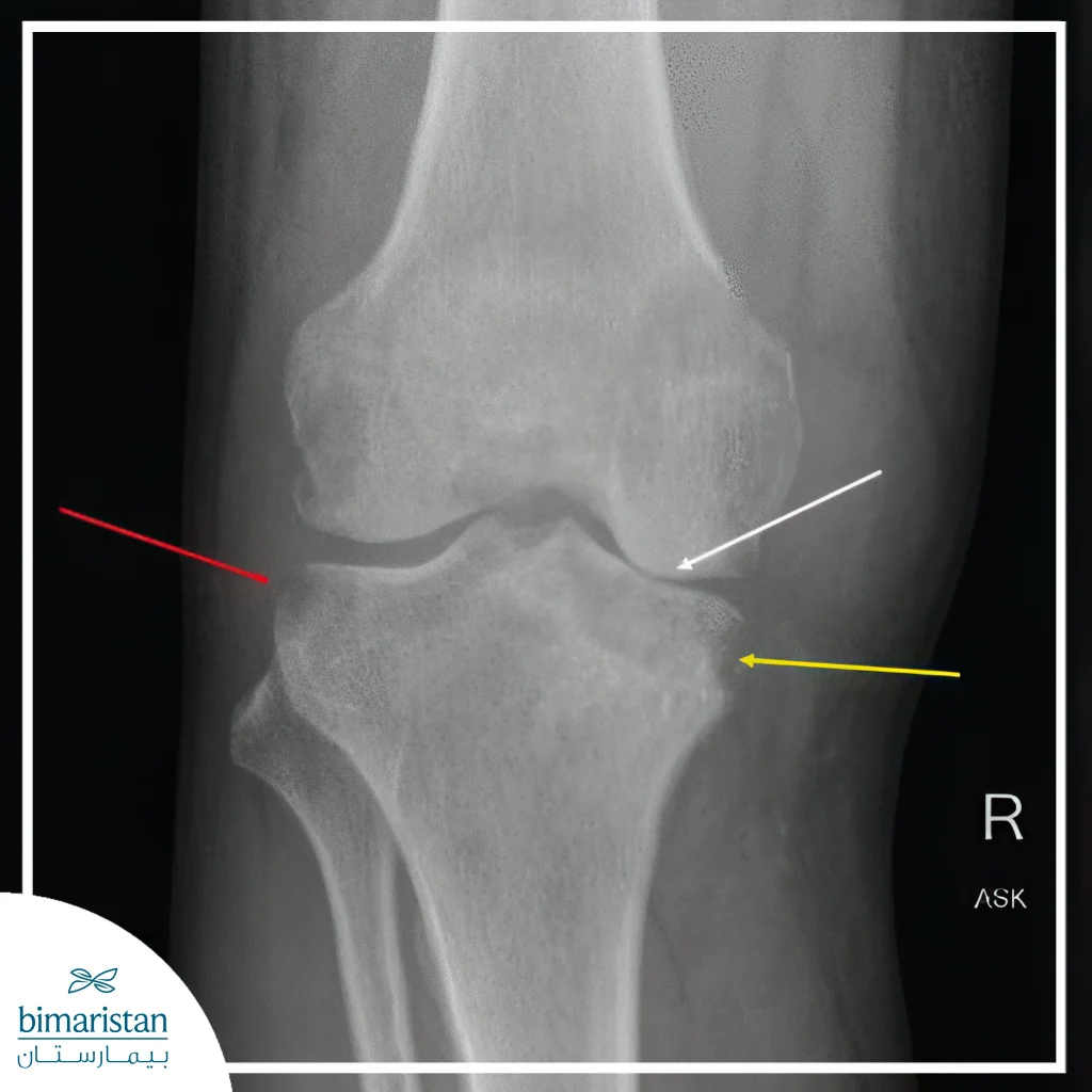 The Displayed Image Is An X-Ray Of The Knee Joint, Showing Signs Of A Pathological Osteal Infection Within The Bones And Joint.