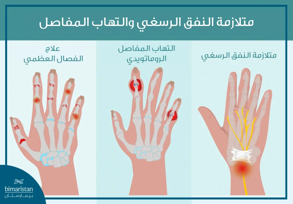 تُظهر الصورة الأنماط المختلفة لالتهابات المفاصل التي قد تصيب اليد والمعصم.