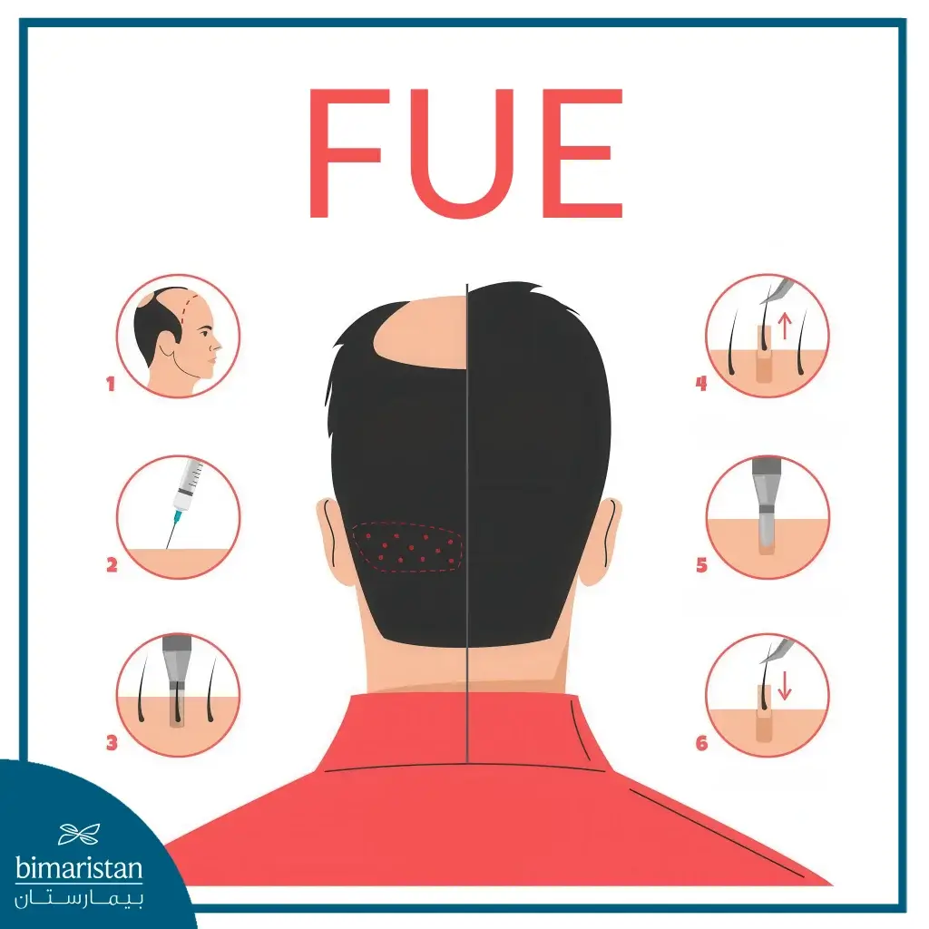 Best Fue Hair Transplant &Amp; Its Cost 3 Stages Of Fue Hair Transplant In Turkey