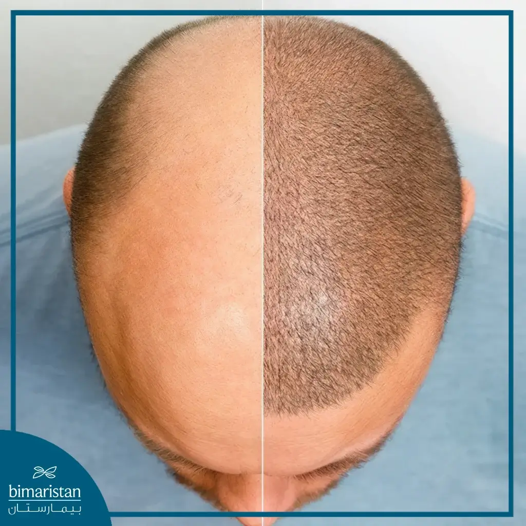 Best Fue Hair Transplant &Amp; Its Cost 4 Fue Hair Transplant Before And After The Operation.