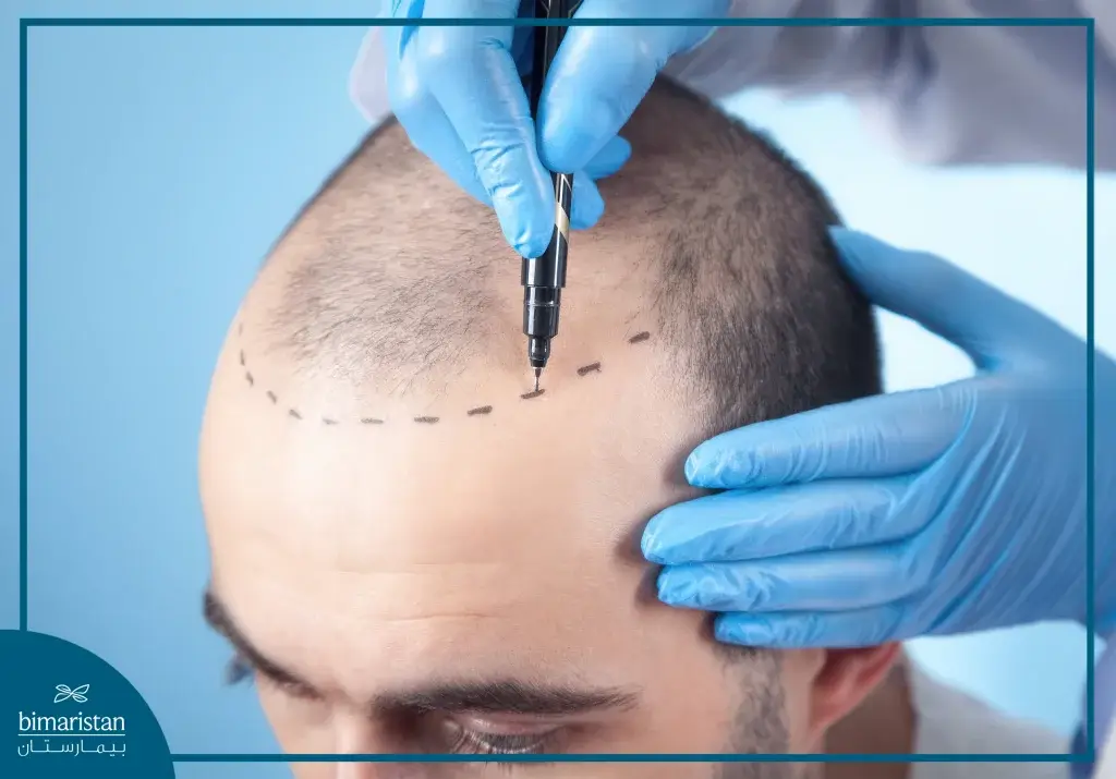زراعة الشعر بطريقة نيوجرافت في تركيا 3 صورة تبين تحديد خط نمو الشعر في مقدمة فروة الرأس قبل زراعة الشعر بطريقة نيوجرافت