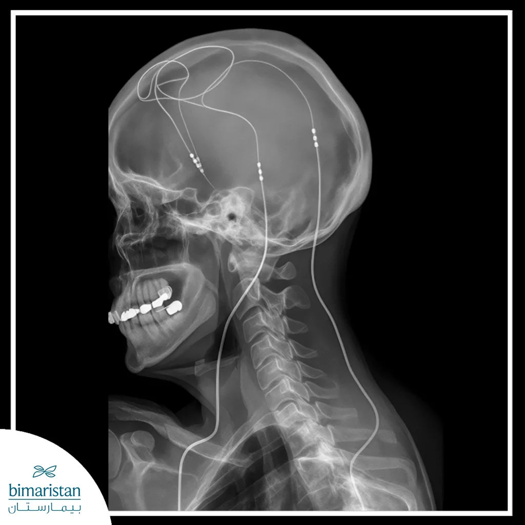 Dbs Battery Replacement: When Parkinson’s Patients Need It And Why 3 Radiographic View Showing The Path Of The Stimulation Wire From The Chest To The Brain