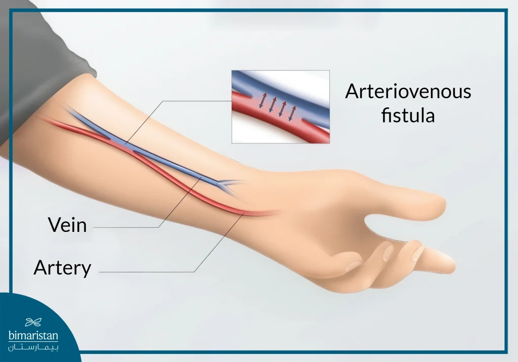 Dialysis Fistula: What Is An Arteriovenous Shunt And How It Works 3 A Dialysis Fistula Is Often An Arteriovenous Fistula In The Forearm.