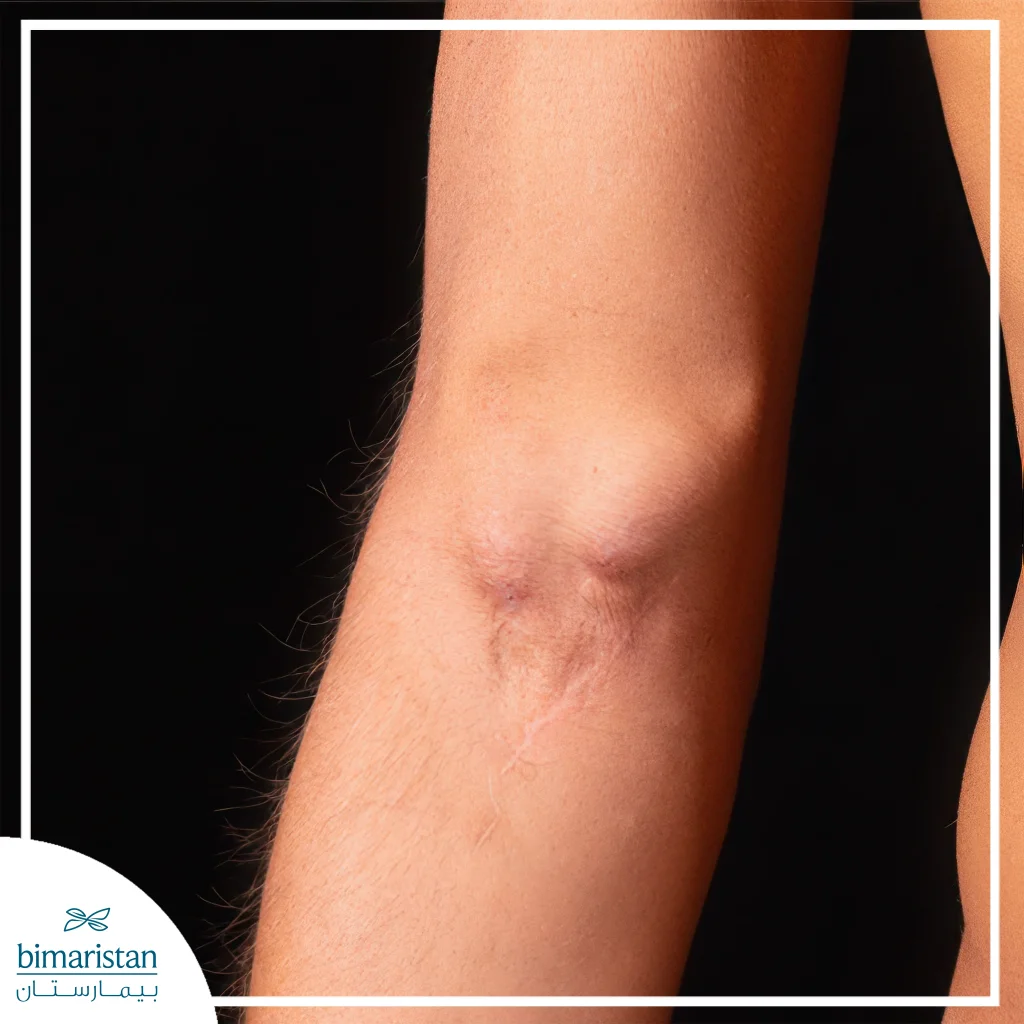 Dialysis Fistula: What Is An Arteriovenous Shunt And How It Works 4 A Swelling In The Vein May Form As A Result Of The Use Of A Dialysis Fistula.