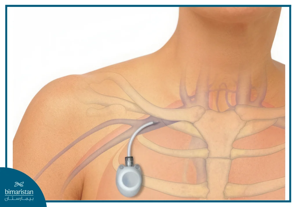 Port Catheter Placement: Central Venous Access Procedure In Turkey 4 The Central Venous Catheter Is Usually Placed In The Right Subclavian Vein In Turkey And The Port Catheter Is Implanted Under The Skin Of The Chest Via Port Catheter Placement.