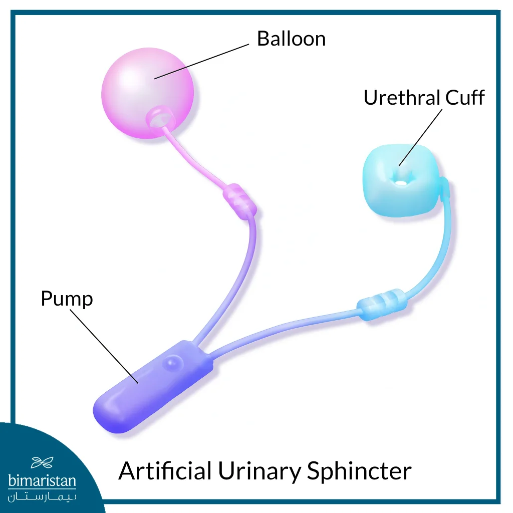 Artificial Urinary Sphincter Implantation 2 Components Of The Artificial Urinary Sphincter