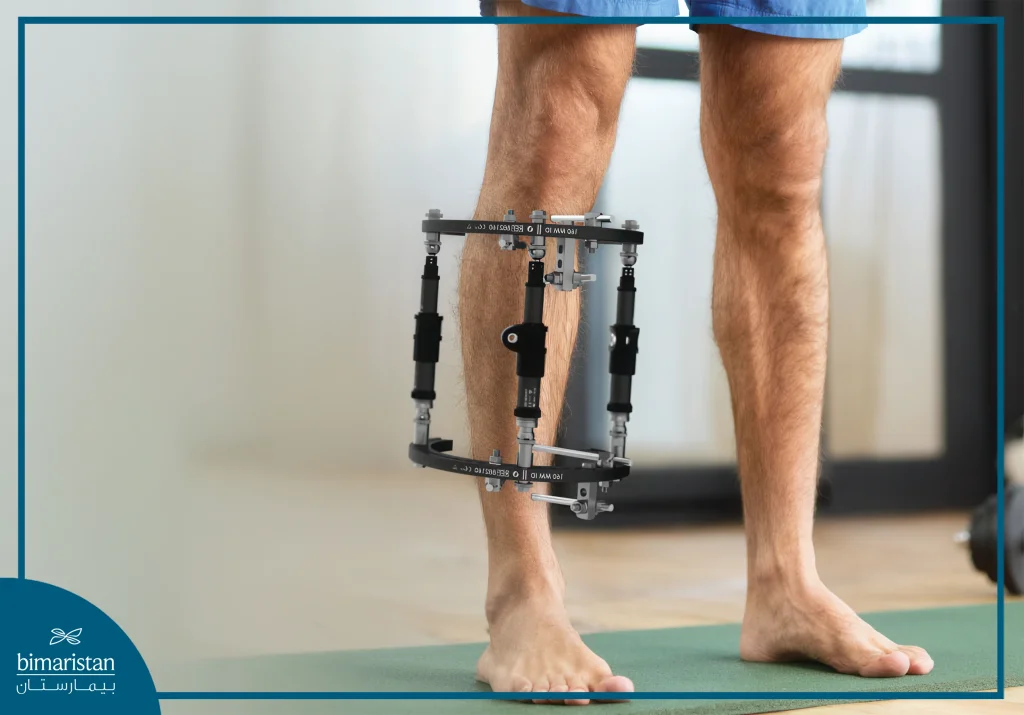 Limb Lengthening With External Fixator: Realistic Results &Amp; Precise Steps 6 Physical Therapy With Exercise After Lengthening With An External Stabilizer