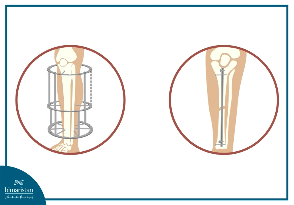Limb Lengthening With External Fixator: Realistic Results &Amp; Precise Steps 5 The Difference Between An External Stabilizer And An Internal Stabilizer In Pictures
