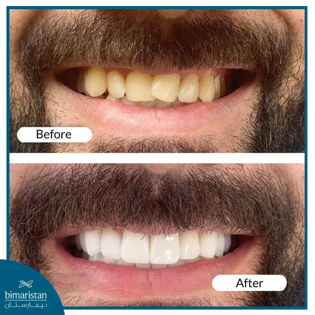 Zirconium Veneers In Turkey: Types, Benefits &Amp; Latest Tech 3 Before And After Zirconium Dental Crowns